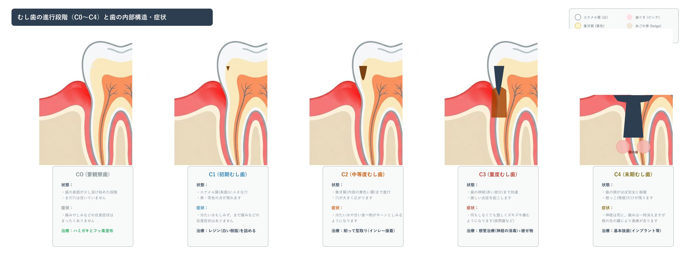 むし歯の進行ステージC1からC4とは？重症度で変わる治療方法と通院回数