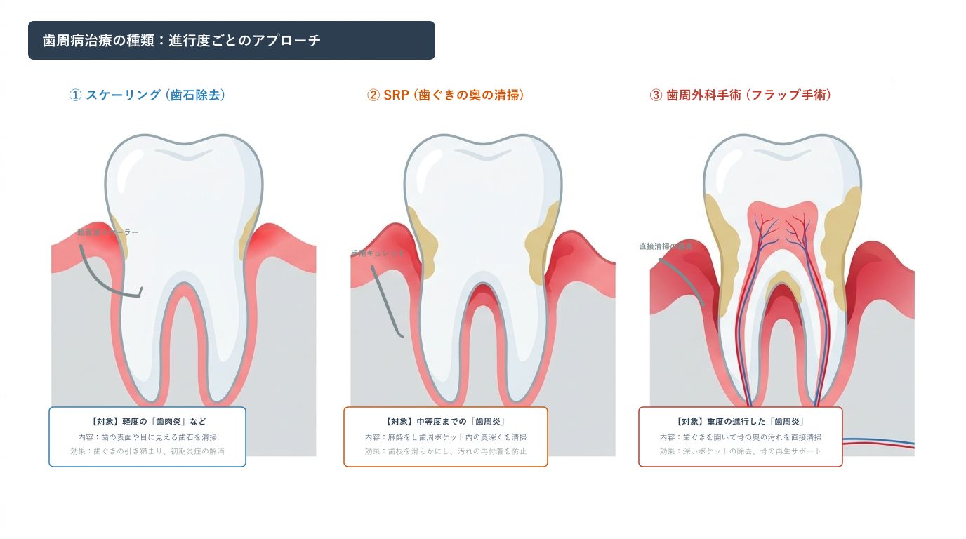 ただの歯石取りだけ？重症度で全く異なる「歯周病治療」の種類と進め方