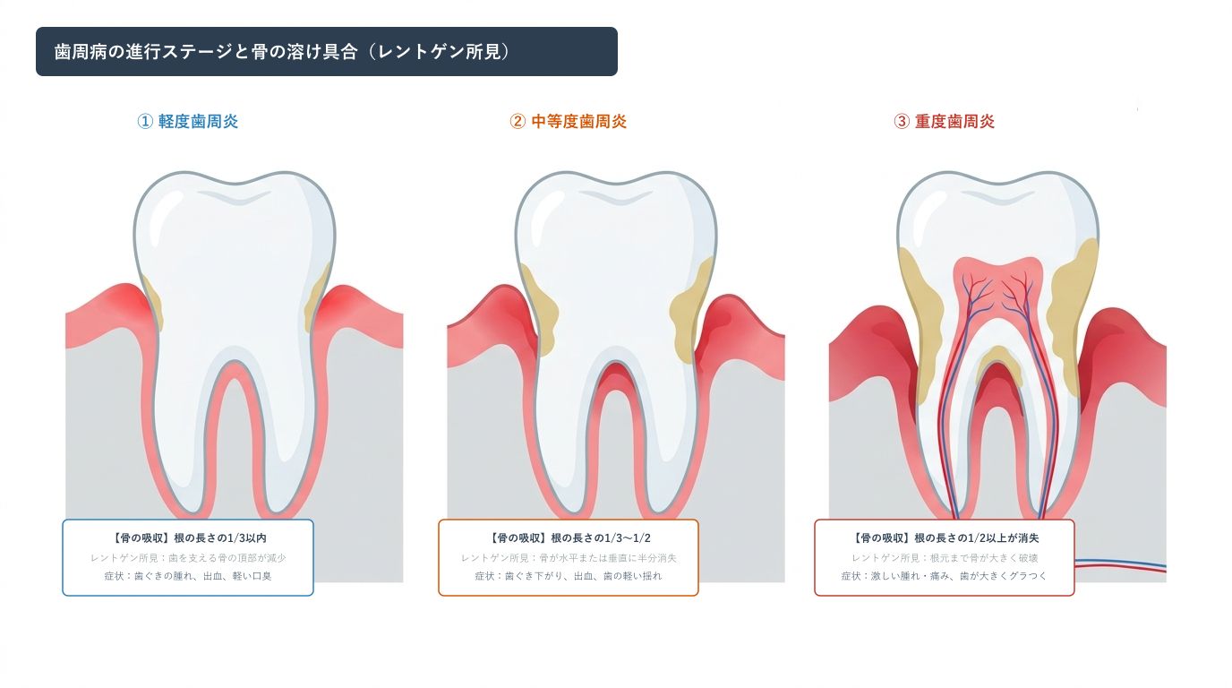 骨が溶ける前に気づくには？歯周病の３ステージ（軽度・中等度・重度）とレントゲン所見